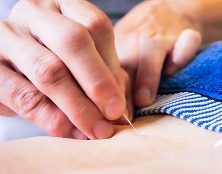 Acupuncture for Pain Treatment